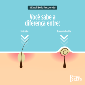 diferença entre Foliculite e Pseudofoliculite