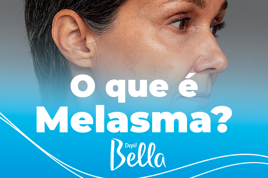 O que é Melasma? Como ele influencia na depilação.
